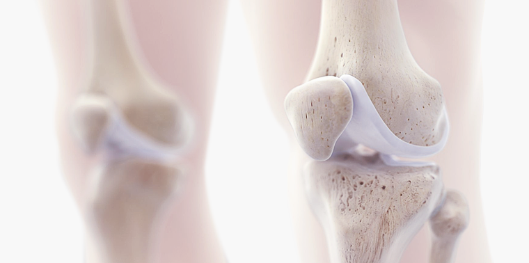representação dos ossos do joelho com lesão de cartilagem localizada na patela