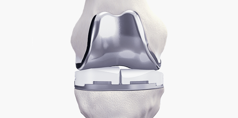 Prótese Total do Joelho